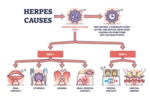 HSV causes