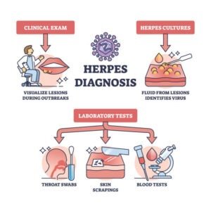 Diagnosis of Herpes Simplex Virus (HSV)