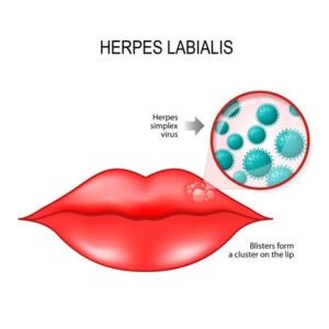 Herpes Simplex Virus (HSV)