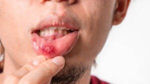 Mouth Sores and Lesions
