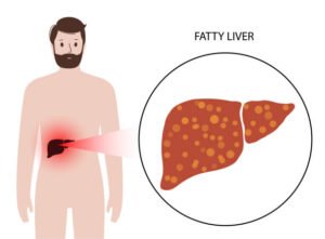 Fatty Lever Symptoms in Hindi