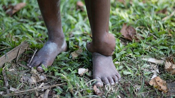 Elephant Foot Disease Elephantiasis
