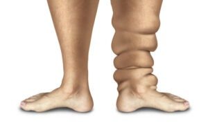 Elephant Foot Disease Elephantiasis